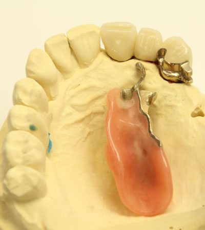 Riegeltechnik | Dental Studio Feindler GmbH