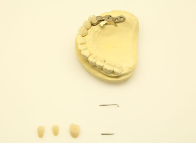 Riegeltechnik | Dental Studio Feindler GmbH