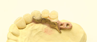 Riegeltechnik | Dental Studio Feindler GmbH