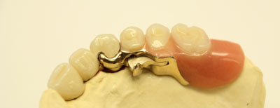 Riegeltechnik | Dental Studio Feindler GmbH