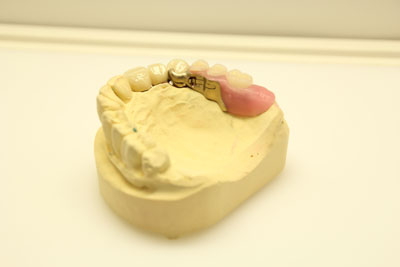 Riegeltechnik | Dental Studio Feindler GmbH