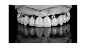 implantatgetragene teleskopbrück