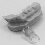 interimsprothese 1 f&s dsf
