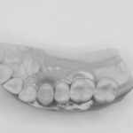 interimsprothese 2 f&s dsf